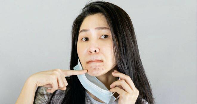 En la época del coronavirus, muchas personas tuvieron que aprender cómo lidiar con el "maskne", el acné por el uso de la mascarilla/Foto: Getty Images