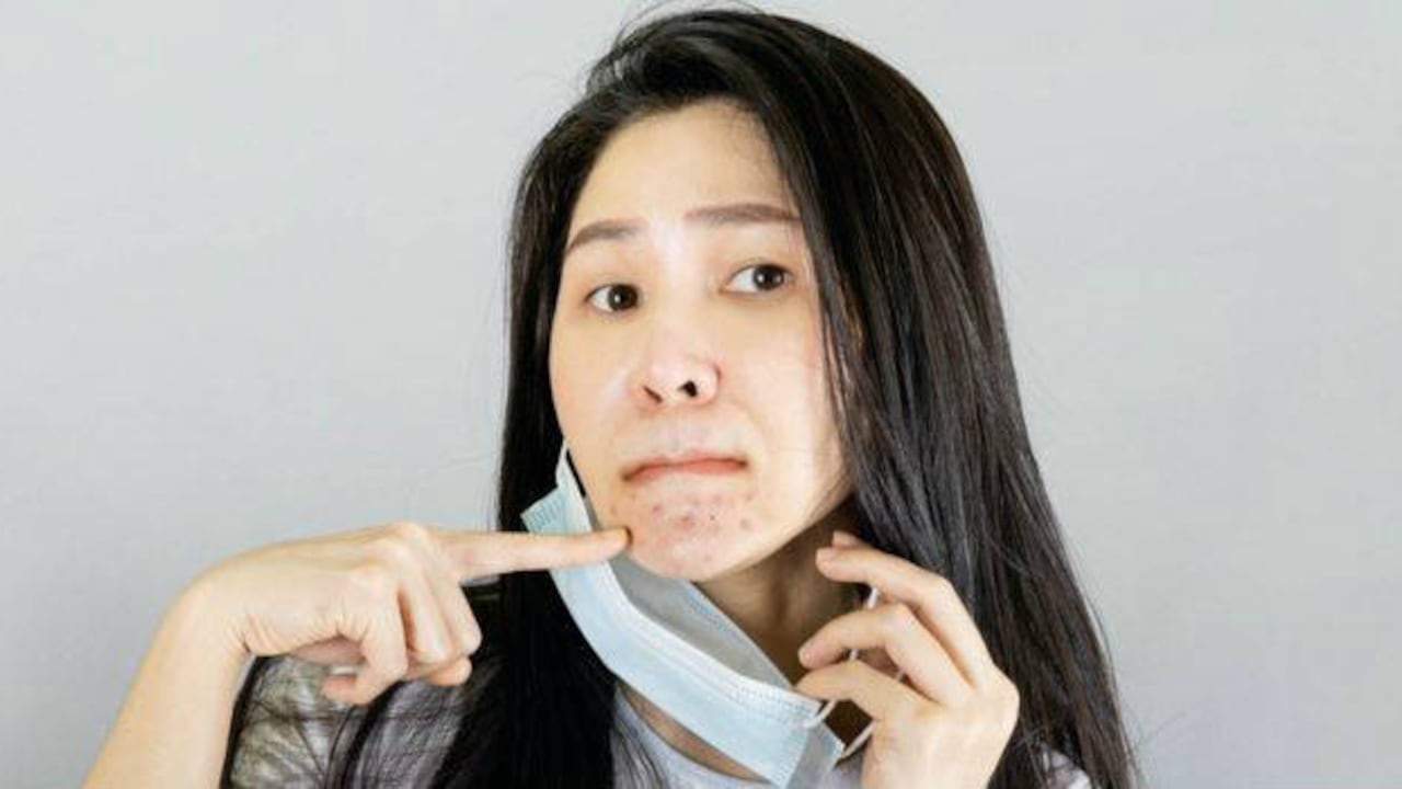 Coronavirus: cómo lidiar con el "maskne", el acné por el uso de la mascarilla/Foto: Getty Images