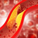 Arterias obstruidas, placa de colesterol en la arteria.