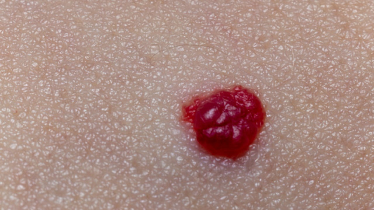 Los puntos rojos en la piel, no son lunares.