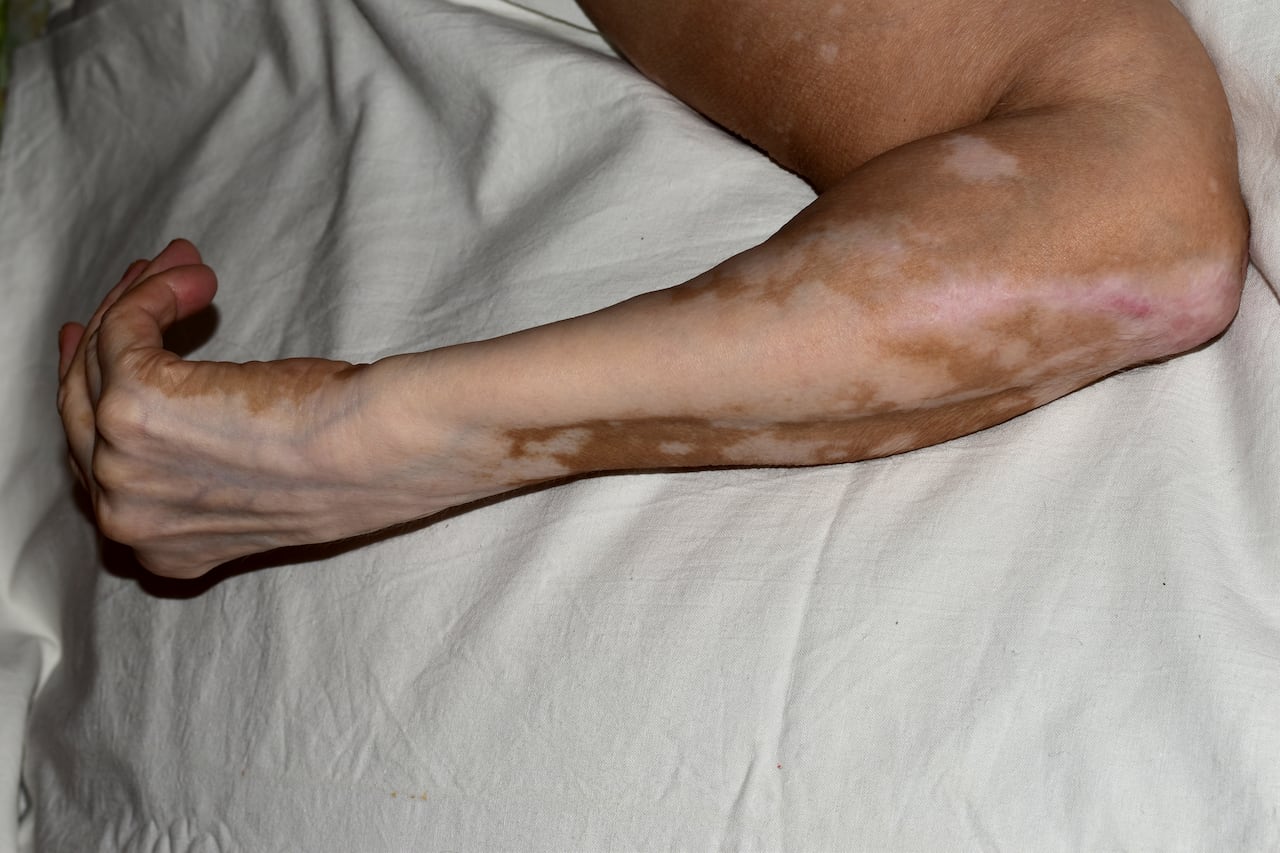Hemocromatosis