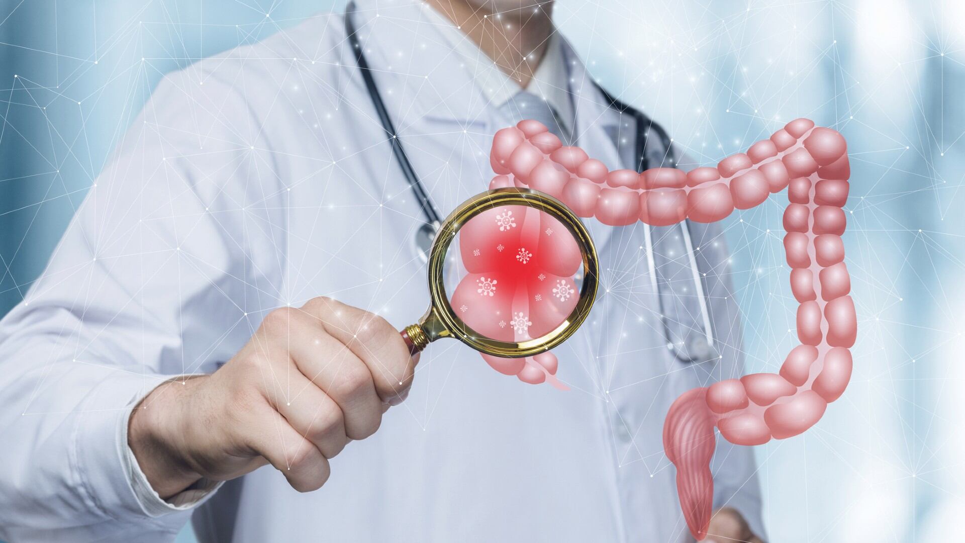 El síndrome de colon irritable es un trastorno frecuente que afecta el estómago y los intestinos.