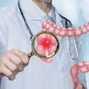 El síndrome de colon irritable es un trastorno frecuente que afecta el estómago y los intestinos.