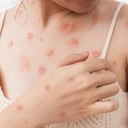 En África es considerada como una enfermedad endémica. Foto: Getty Images