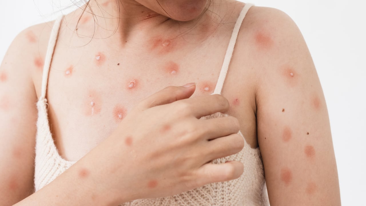 En África, la viruela del modo es considerada como una enfermedad endémica.