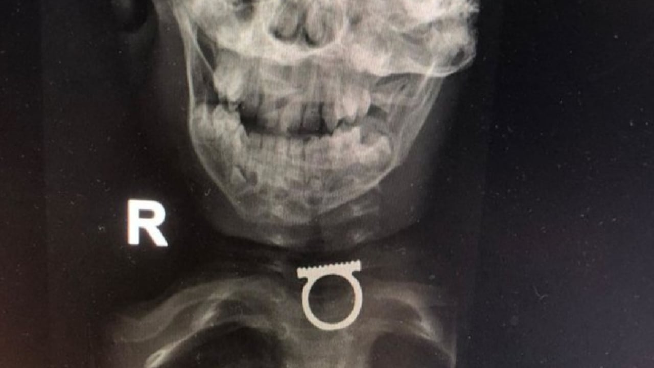 Médicos lograron extraer sin complicaciones el anillo incrustado en la garganta del menor.