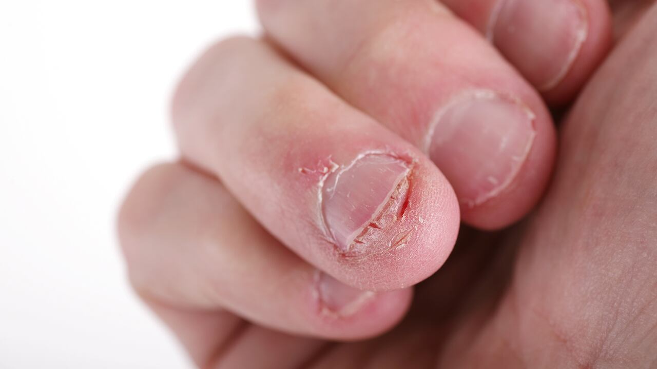 El hongo que infecta las uñas puede ser causado por una mala higiene.