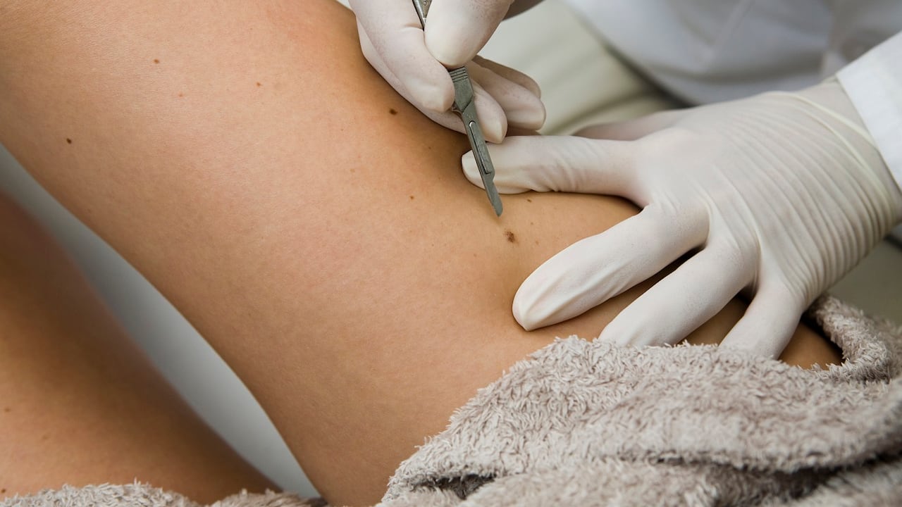 El cáncer de piel puede generarse por la exposición permanente al sol. Imagen de referencia.