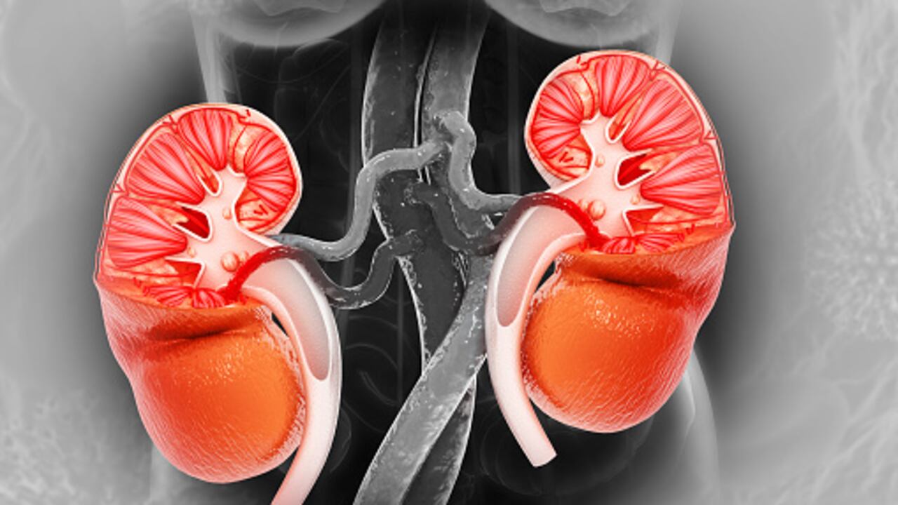 No consumir agua provoca cálculos en los riñones.