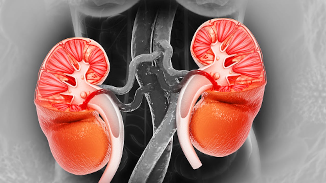 No consumir agua provoca cálculos en los riñones.