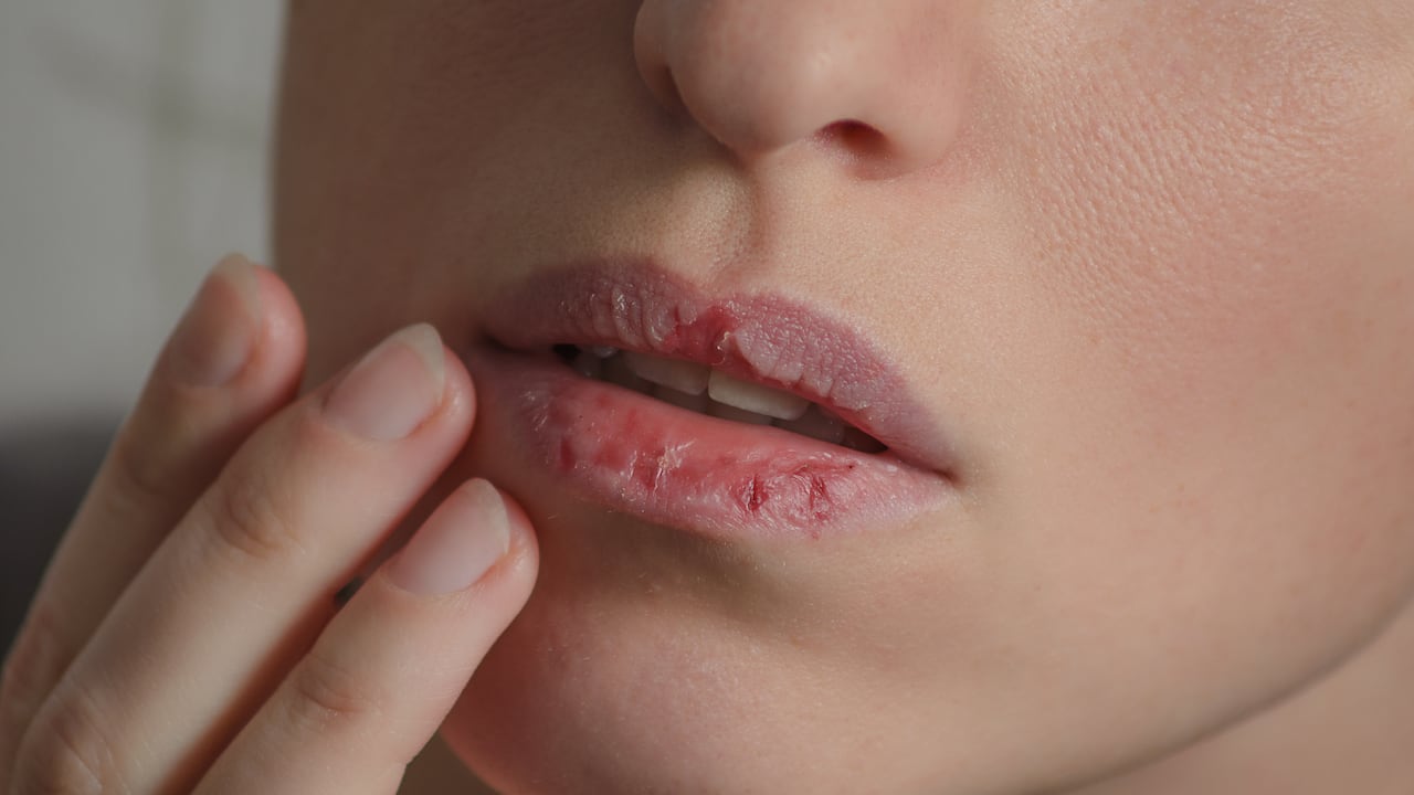 Labios agrietados