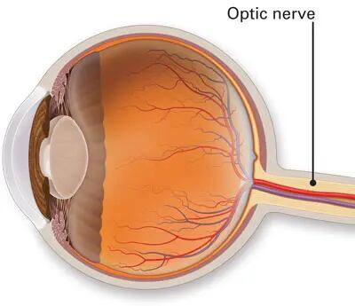 El glaucoma afecta al nervio óptico. (American Academy of Ophthalmology).
