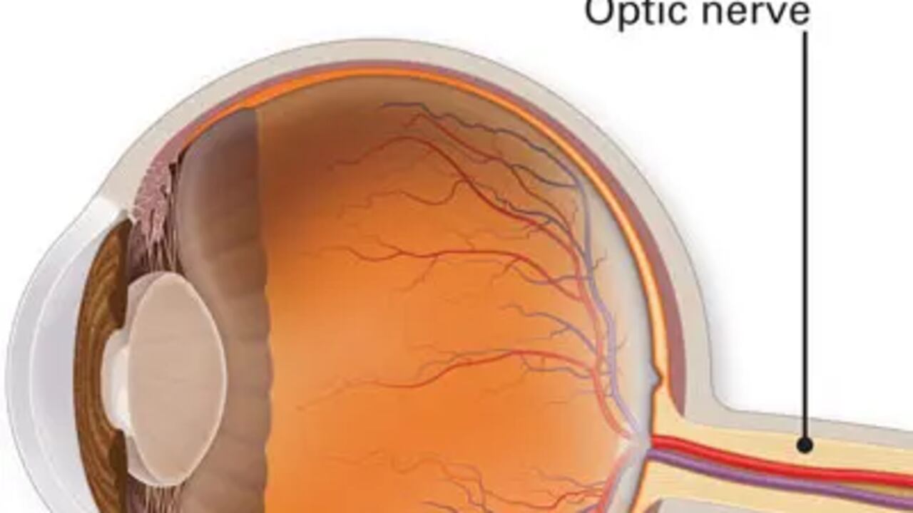 El glaucoma afecta al nervio óptico. (American Academy of Ophthalmology).