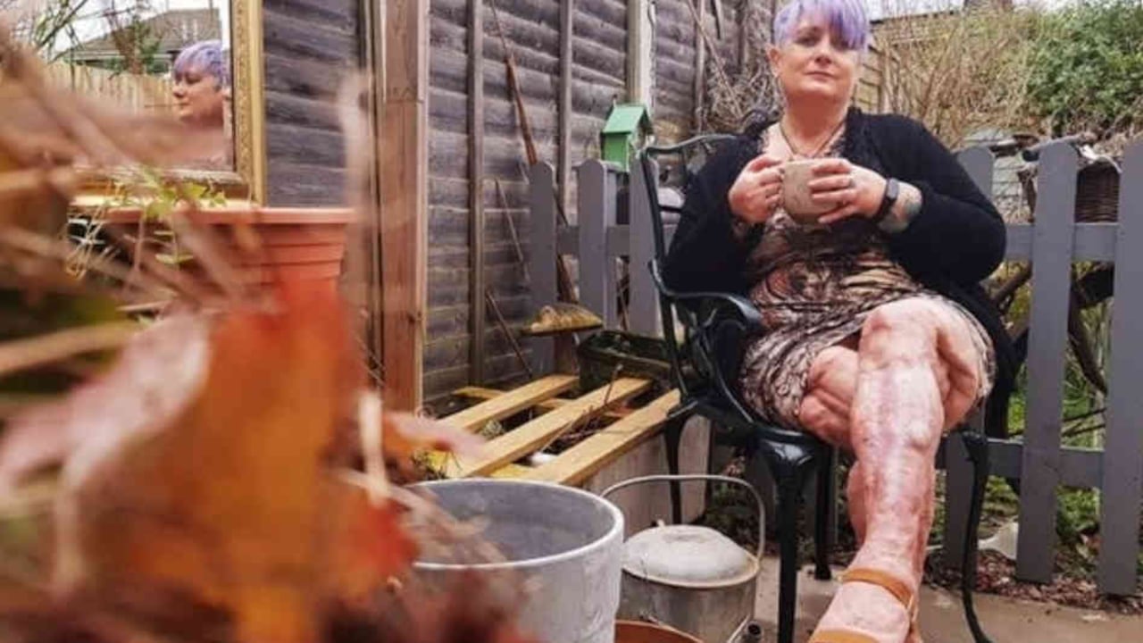 Jayne sentada en su jardín, ya no siente vergüenza de mostrar sus piernas.