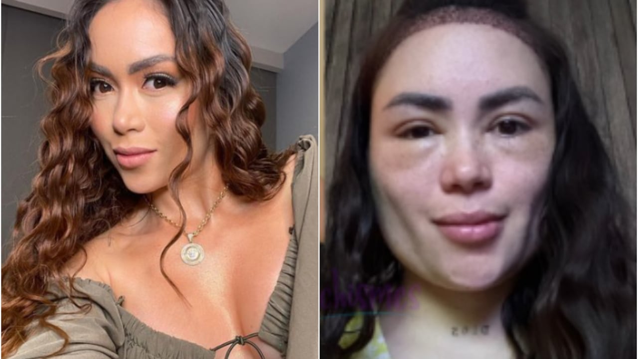 Epa Colombia se realizó un nuevo tratamiento estético, pero tuvo una reacción en el rostro que llamó la atención.