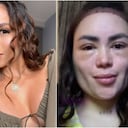 Epa Colombia se realizó un nuevo tratamiento estético, pero tuvo una reacción en el rostro que llamó la atención.