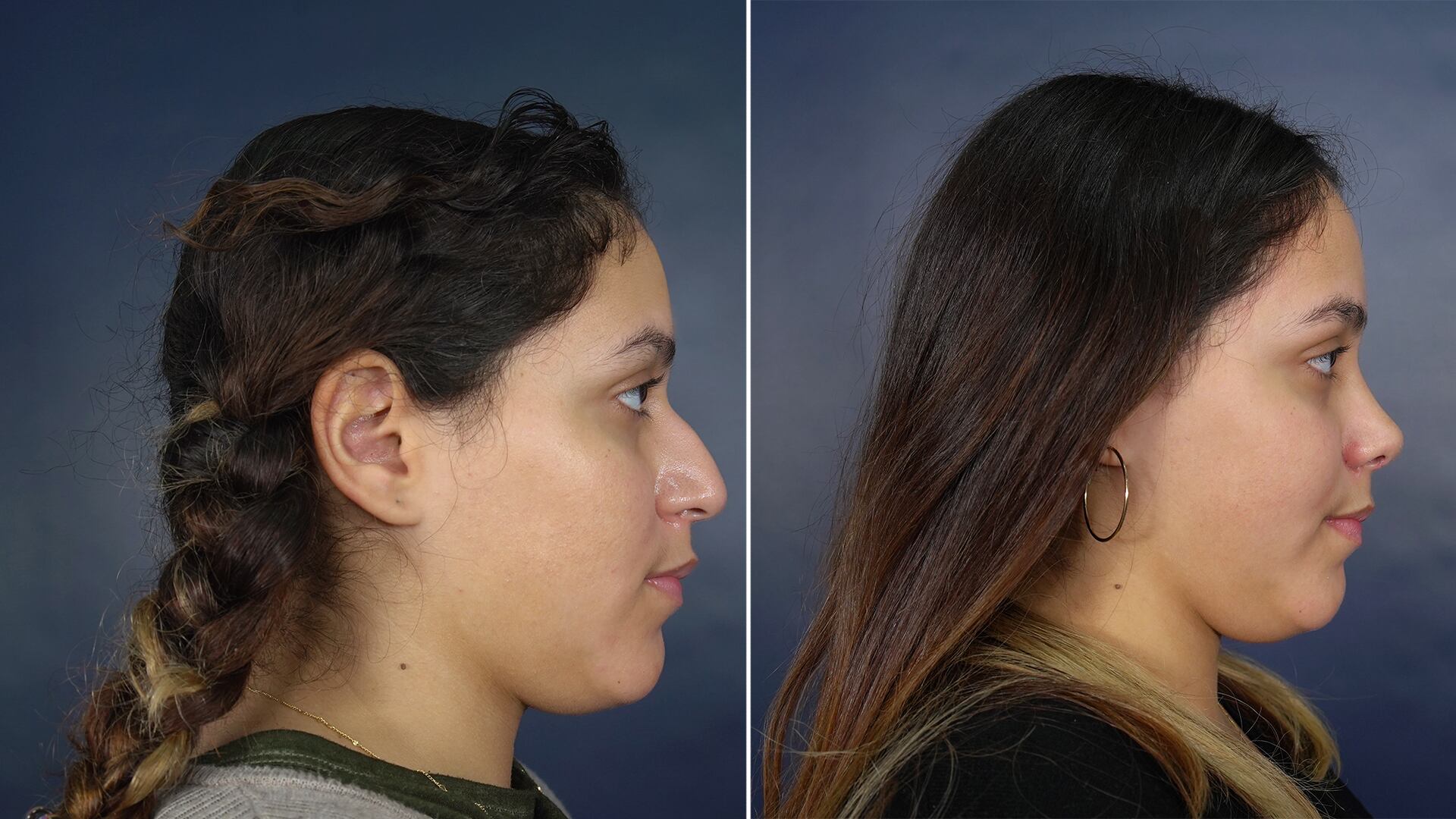 La Rinoplastia Ultrasónica otorga una mayor precisión a la hora de remodelar estructuras óseas y corregir defectos.