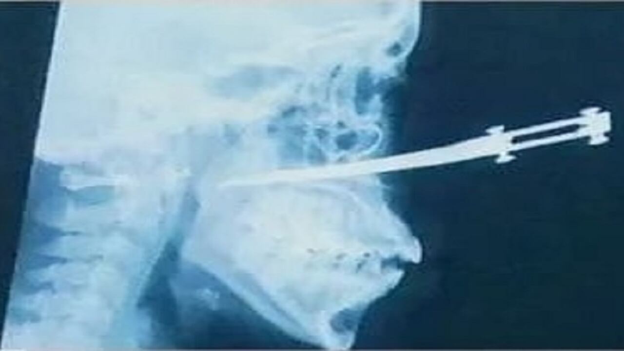 Radiografía del rostro de la mujer en el momento de ser ingresada en el hospital.