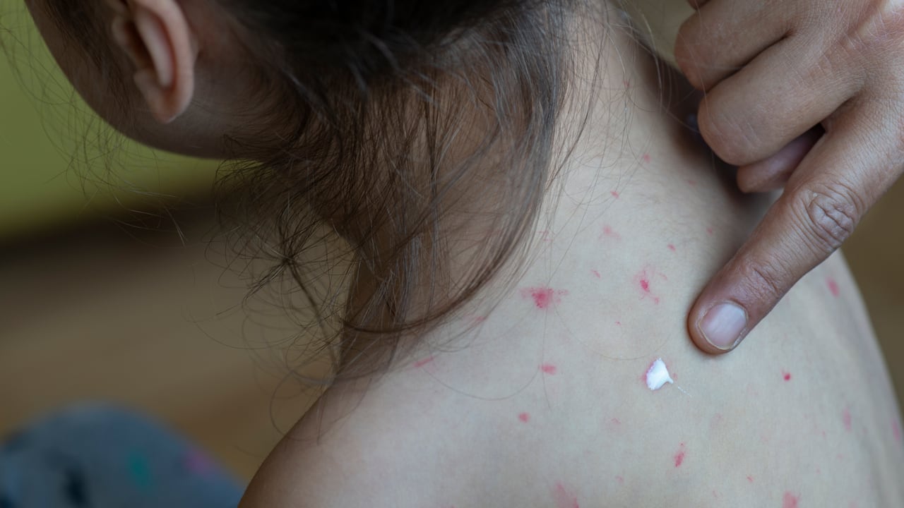Se detectó el primer caso de sarampión en Bogotá en lo corrido del año.