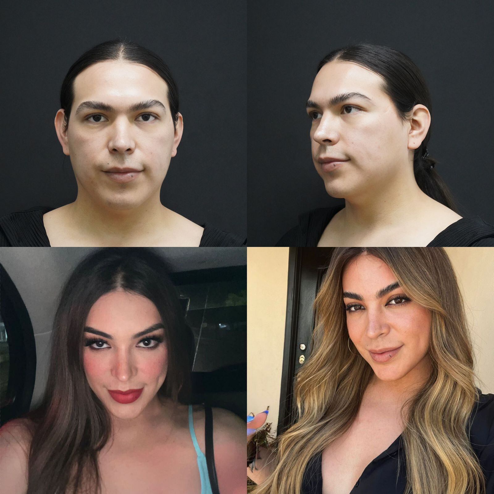 Cirugía de feminización facial realizada por el doctor Ricardo Morales