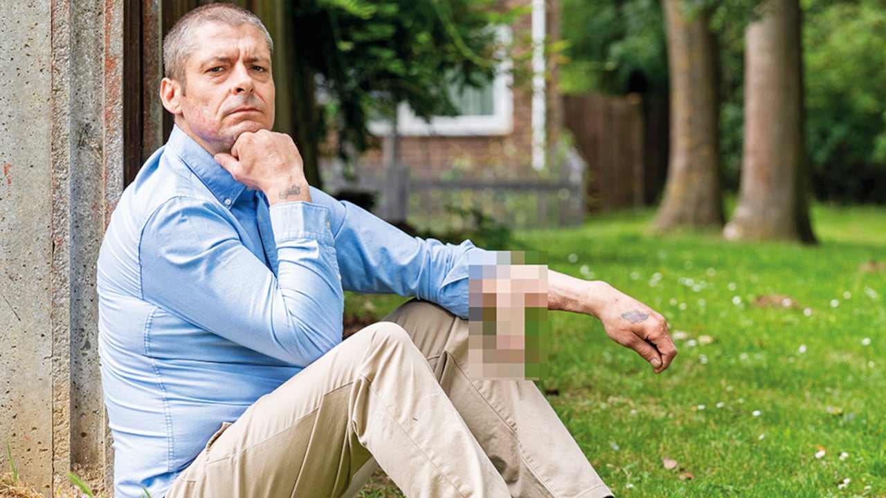 Durante seis años, Malcolm MacDonald debió llevar su pene en el antebrazo y no en el sitio correcto. Gracias a una cirugía, hoy el miembro está en su puesto.