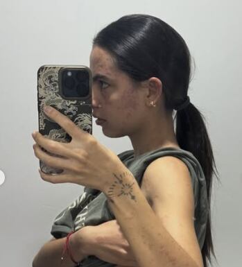 Michelle Orozco, comparte su experiencia con enfermedad autoinmune.