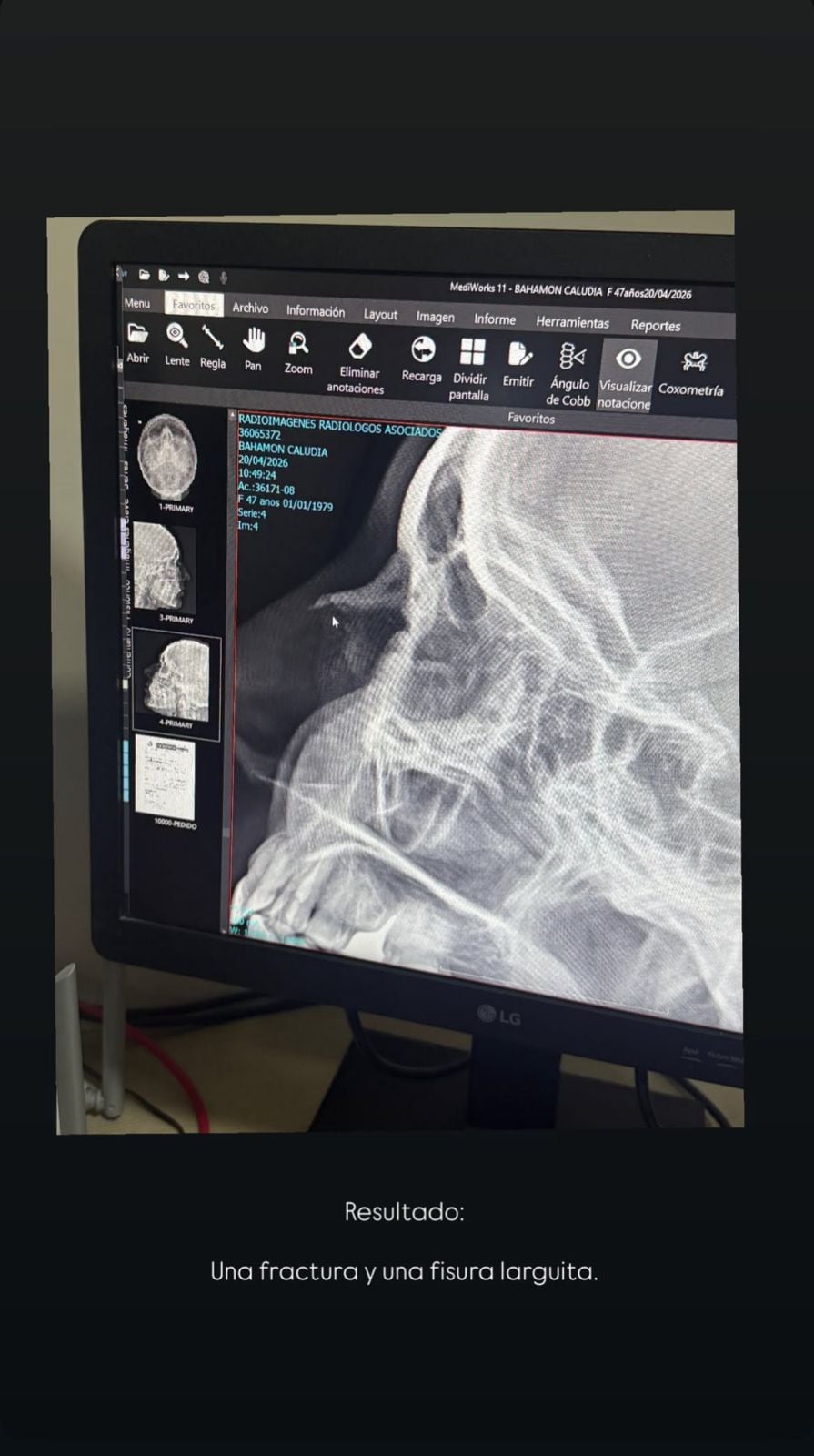 Fractura de Claudia Bahamón.