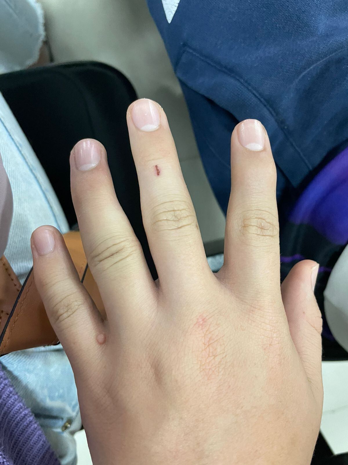 Así se veía el dedo fracturado el primer día