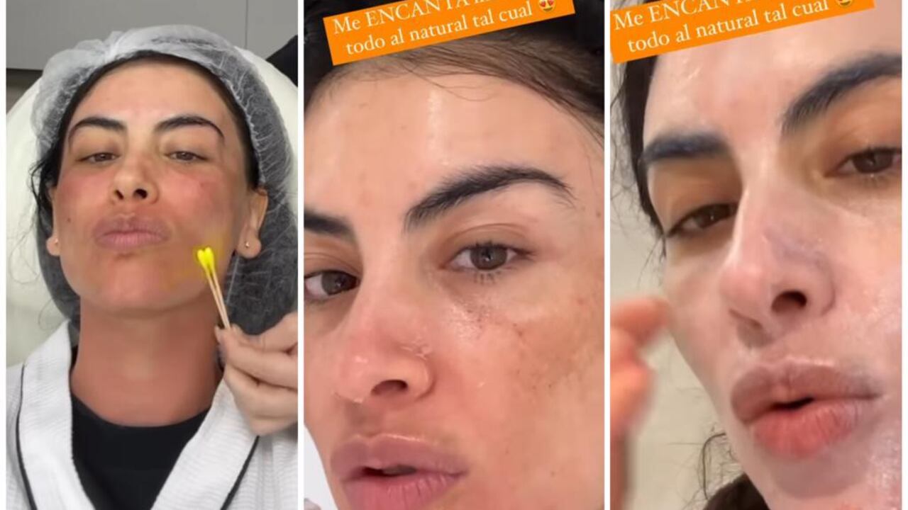 La presentadora de TV se sometió a un tratamiento para mejorar la apariencia de su rostro.