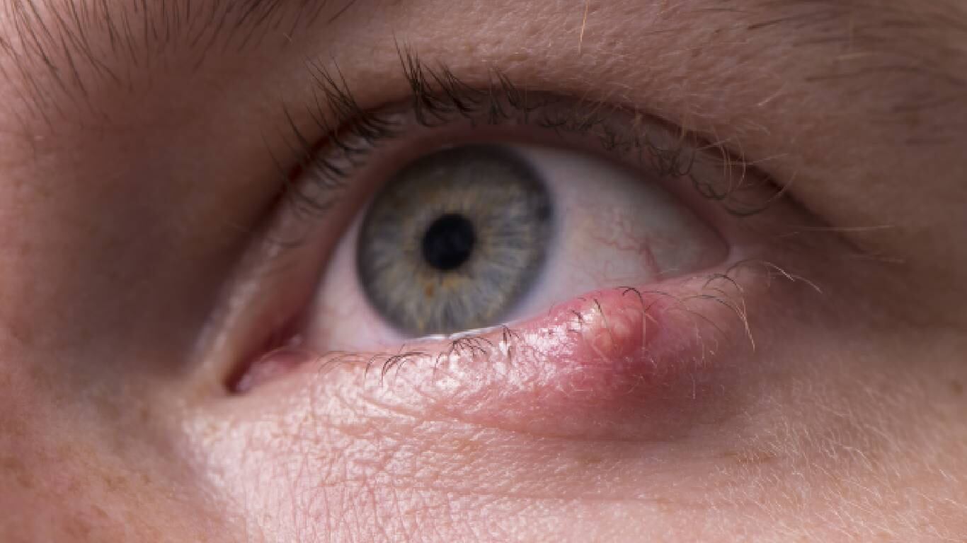 Los orzuelos pueden ser causados por por una infección bacteriana. Foto: Getty Images.