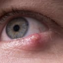 Los orzuelos pueden ser causados por por una infección bacteriana. Foto: Getty Images.