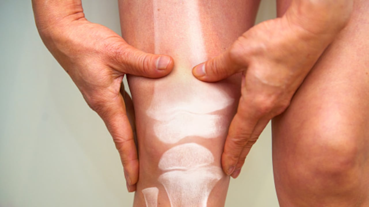Con la artrosis, el cartílago dentro de una articulación empieza a deteriorarse, afectando también la salud de los huesos.