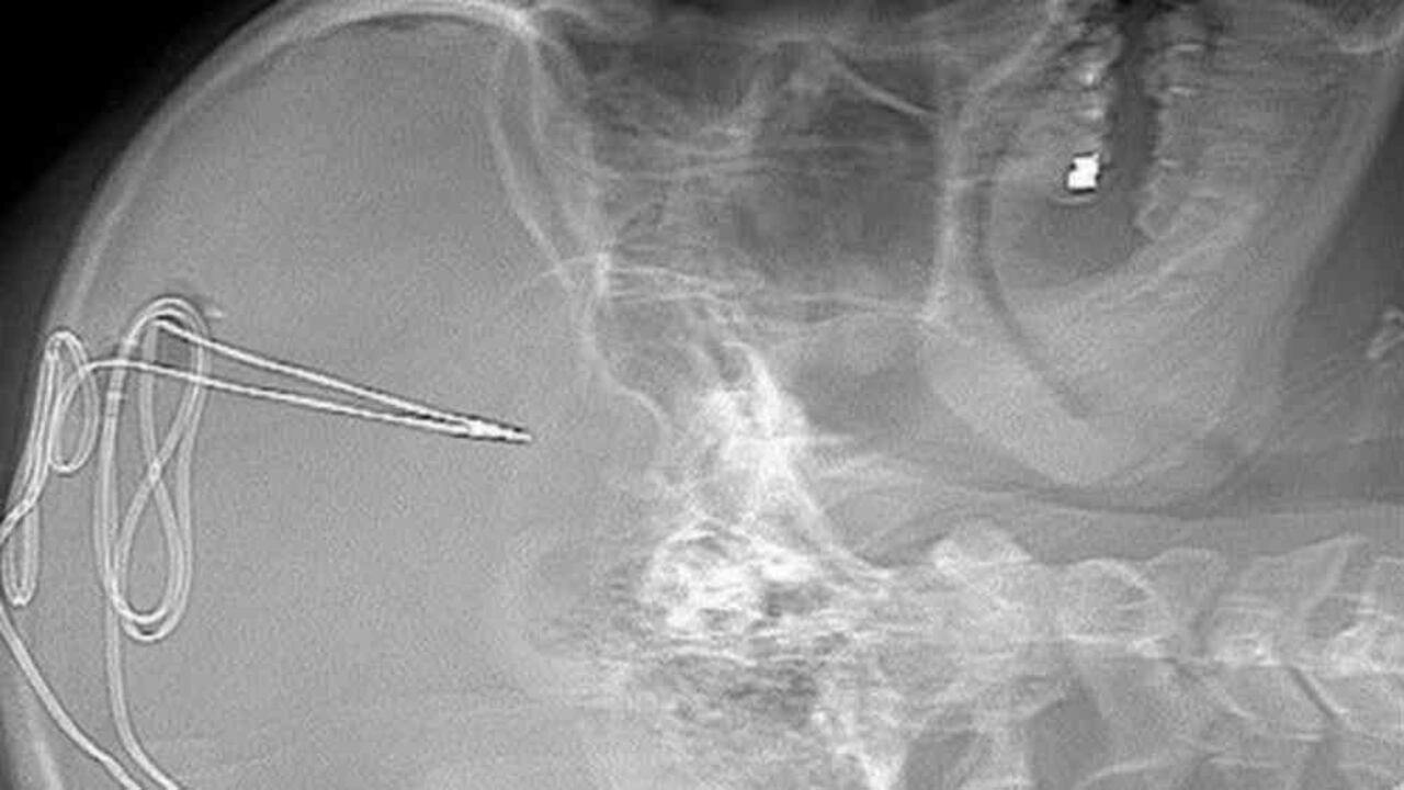 Esta radiografía nuestra cómo es insertado un implante cerebral. FOTO: BBC/ UNIVERSIDAD DE VIRGINIA.