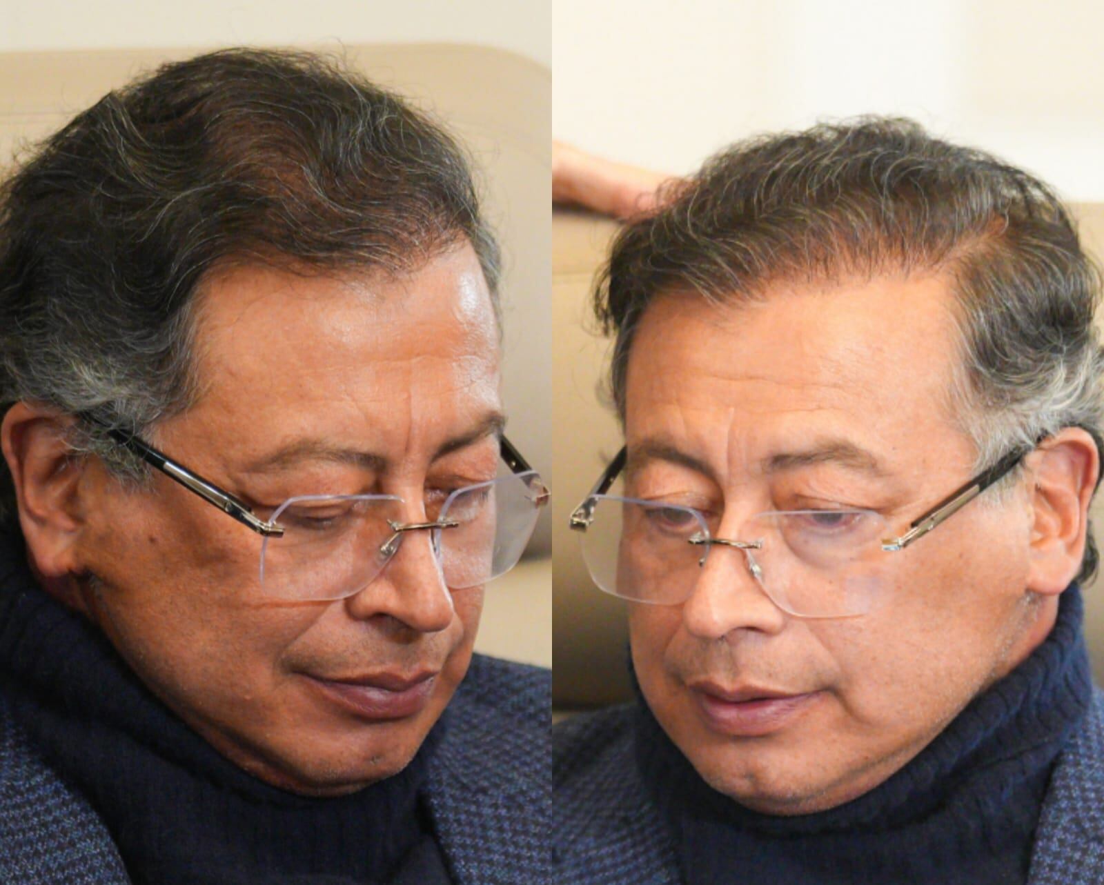 El presidente Petro se sometió a cirugía plástica sin informar al Congreso