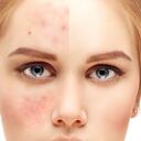 Cuidados en la piel rosácea