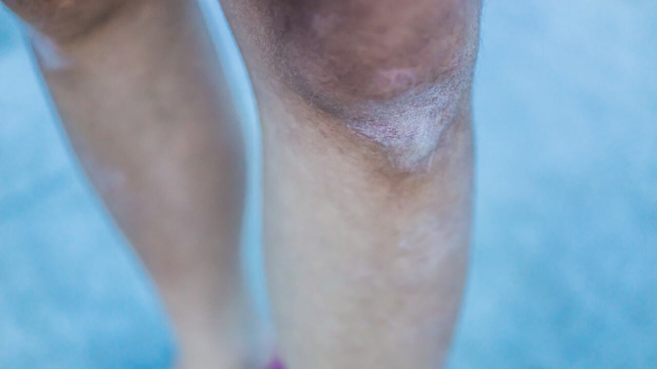 Además de oscurecerse, las rodillas y los codos también tienden a resecarse debido a que no cuentan con suficientes glándulas sebáceas.