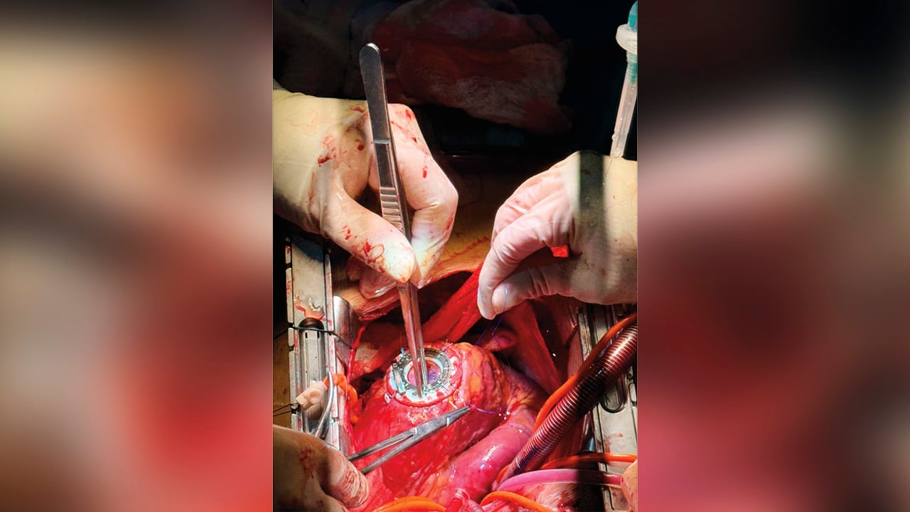 El procedimiento se realizó el miércoles 14 de enero de 2026 en la Clínica General del Norte en Barranquilla. 