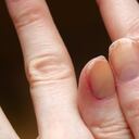 Cracked fingernails with brittle splitting and peeling nails