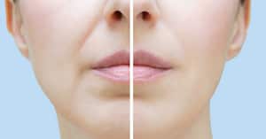 Existen remedios caseros para eliminar estas imperfecciones del rostro.