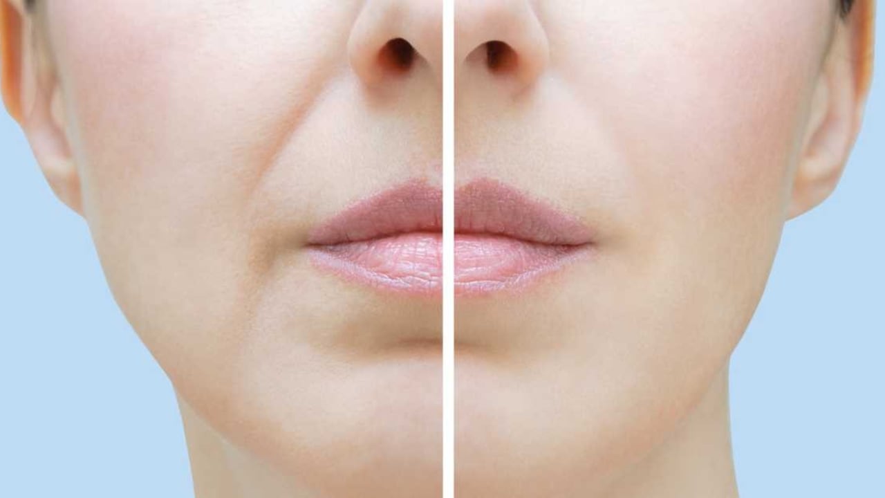 Existen remedios caseros para eliminar estas imperfecciones del rostro.