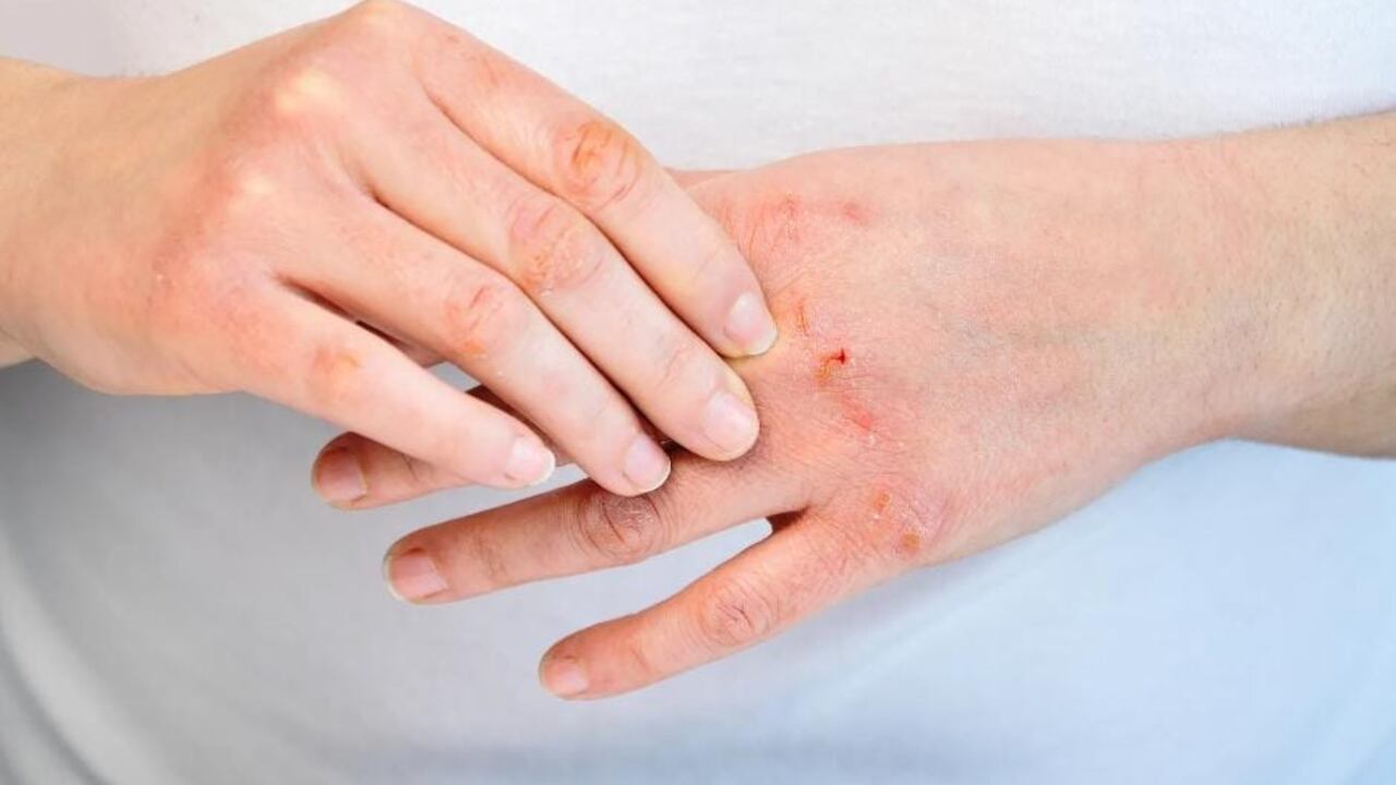 Hasta el momento se desconoce la causa exacta de la aparición de los sabañones.