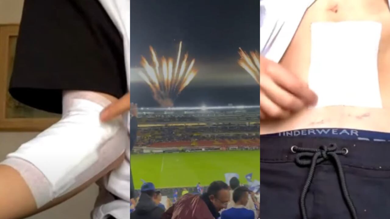 Quemados con pólvora en el juego Millonarios vs. Pasto hablan de lo sufrido por la pólvora