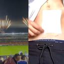 Quemados con pólvora en el juego Millonarios vs. Pasto hablan de lo sufrido por la pólvora