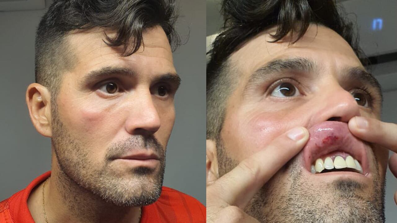 Así le quedó el rostro a José Micciulli, preparador físico de Unión Magdalena.