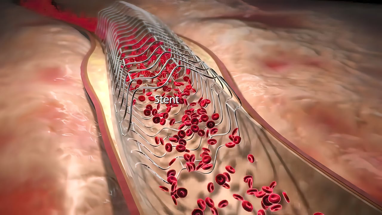 Los triglicéridos elevados pueden ocasionar complicaciones de salud.