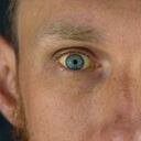 Según la American Cancer Society el cáncer de ojo se deriva en varios tipos.