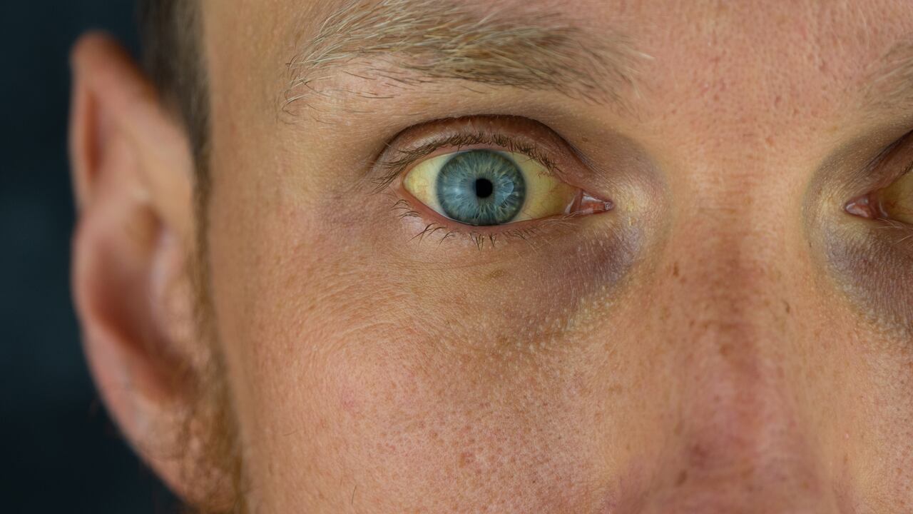 Según la American Cancer Society, el cáncer de ojo se deriva en varios tipos.