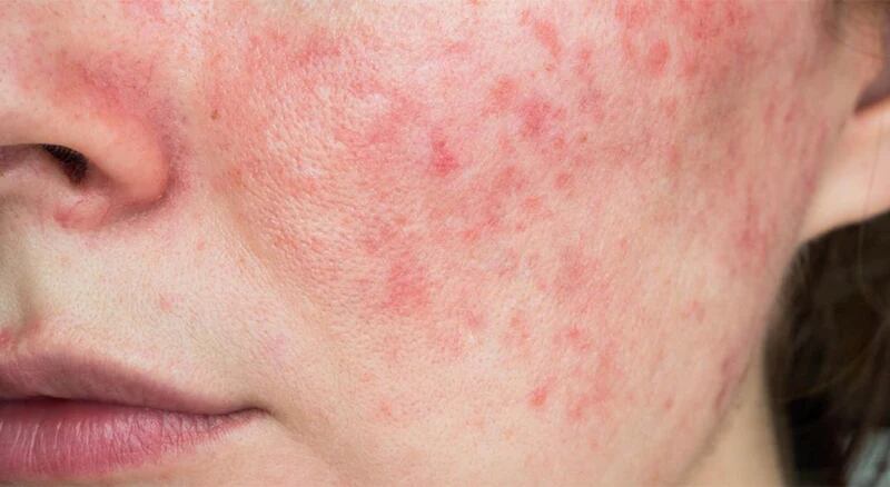 Rosácea: La enfermedad que tiene Sebastián Martínez.