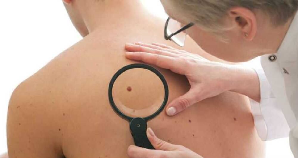 hay que visitar al médico si se observan anomalías en la piel