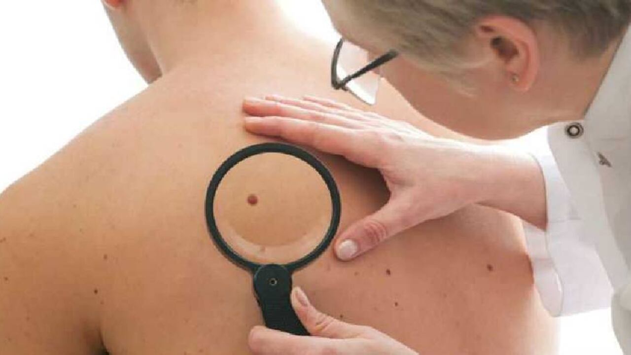 Los lunares pueden terminar convirtiéndose en melanomas.